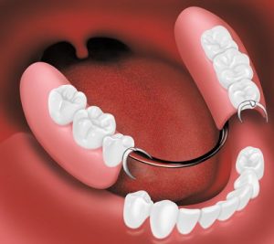 Partial Dentures