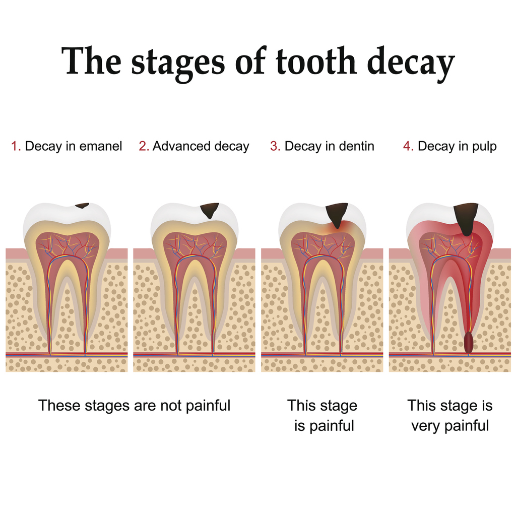 Tooth decay formation