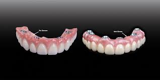 Full Arch Supported Implant