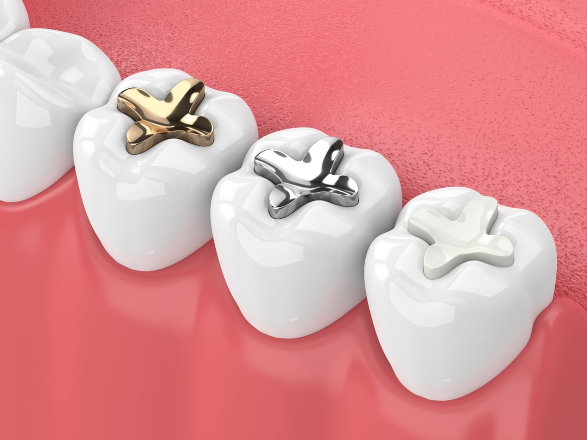 dental fillings gold silver composite dental fillings gold silver composite